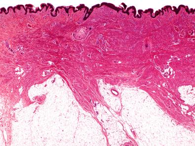 Figure 15.17, Dermatomyofibroma.