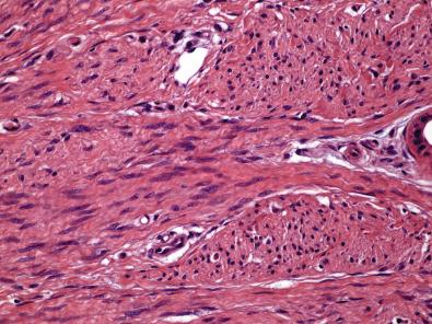 Figure 15.18, Dermatomyofibroma.