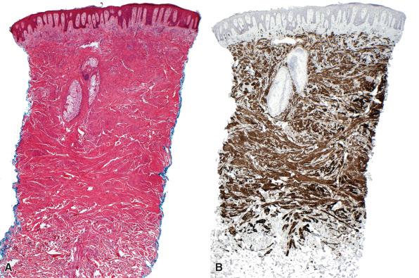 Figure 15.20, Pilar Leiomyoma.