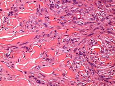 Figure 15.2, Benign Fibrous Histiocytoma.