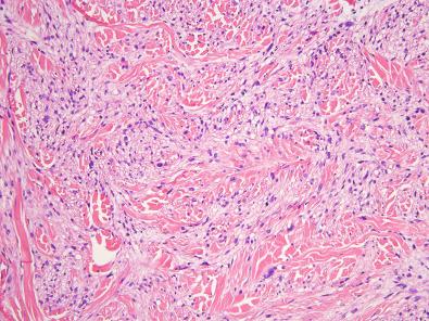 Figure 15.23, Atypical Intradermal Smooth Muscle Neoplasm.