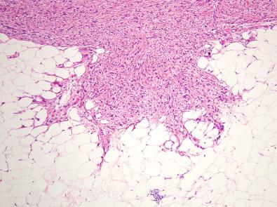 Figure 15.25, Cutaneous Leiomyosarcoma.