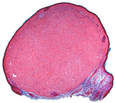 Figure 15.26, Storiform Collagenoma.