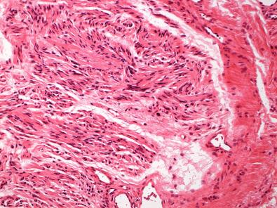 Figure 15.30, Solitary Circumscribed Neuroma.