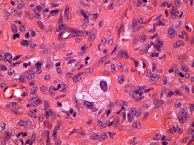 Figure 15.3, Benign Fibrous Histiocytoma.