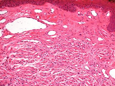 Figure 15.31, Solitary Circumscribed Neuroma.