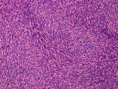 Figure 15.37, Dermatofibrosarcoma Protuberans.