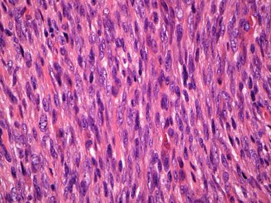 Figure 15.38, Dermatofibrosarcoma Protuberans.