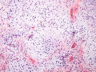 Figure 15.39, Dermatofibrosarcoma Protuberans.