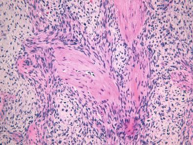 Figure 15.40, Dermatofibrosarcoma Protuberans.