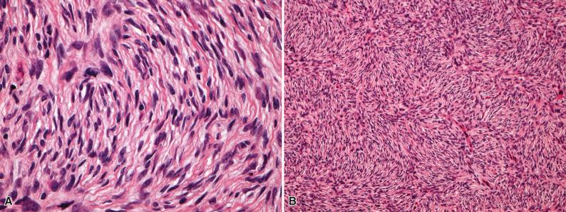 Figure 15.34, Dermatofibrosarcoma Protuberans.