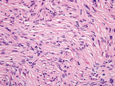 Figure 15.36, Dermatofibrosarcoma Protuberans.