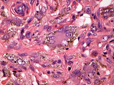 Figure 15.4, Benign Fibrous Histiocytoma.