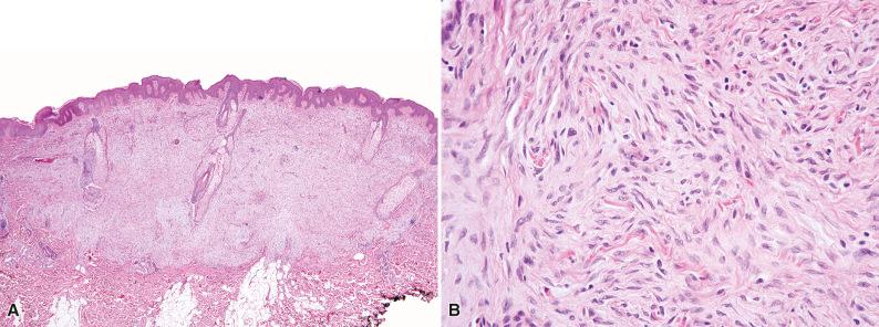 Figure 15.42, Plaquelike Dermal Fibroma.