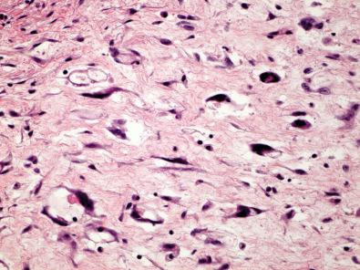 Figure 15.45, Giant Cell Fibroblastoma.