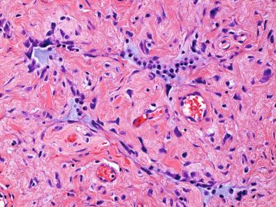 Figure 15.46, Giant Cell Fibroblastoma.