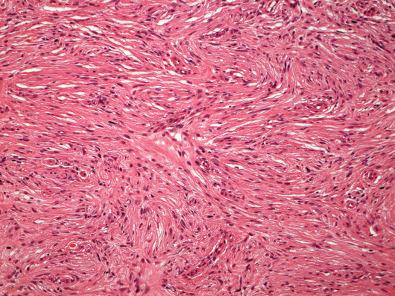 Figure 15.48, Perineurioma.