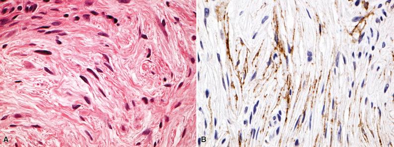 Figure 15.49, Perineurioma.