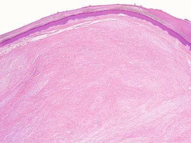 Figure 15.50, Hybrid Schwannoma/Perineurioma.