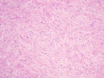 Figure 15.51, Hybrid Schwannoma/Perineurioma.