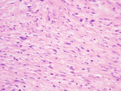 Figure 15.52, Hybrid Schwannoma/Perineurioma.