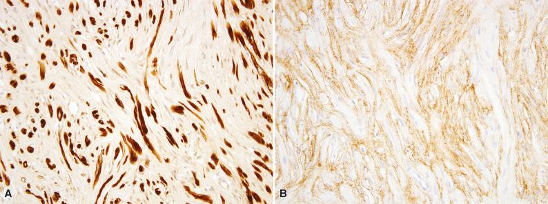 Figure 15.53, Hybrid Schwannoma/Perineurioma.