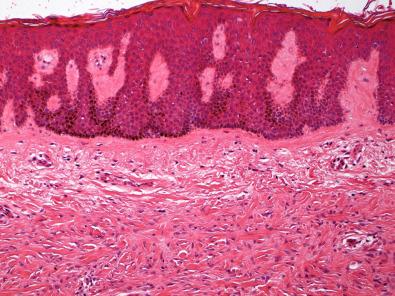 Figure 15.6, Benign Fibrous Histiocytoma.