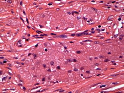 Figure 15.9, Benign Fibrous Histiocytoma.