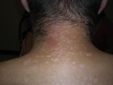 Figure 19.2, Pityriasis versicolor-like lesions, widespread on the trunk, found to be induced by several EVHPVs.