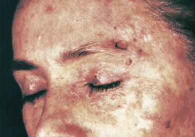 Figure 19.3, Wart-like lesions on the face, some larger, deeper, covered with crusts (early carcinoma in situ).