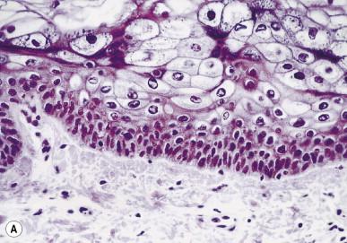 Figure 19.4, A) Characteristic cytopathic effect of EVHPV-induced lesion. Clariﬁed dysplastic cells, starting suprabasally, with small pyknotic nuclei, replacing almost the entire epidermis. B) Molecular hybridization in situ showing abundant EVHPV5 DNA in the clariﬁed cells.