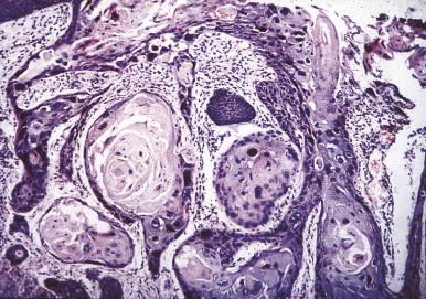 Figure 19.5, Carcinoma Bowen's type with numerous dyskeratotic and pleomorphic cells in and around hair follicles, which are partly ﬁlled with keratotic masses.