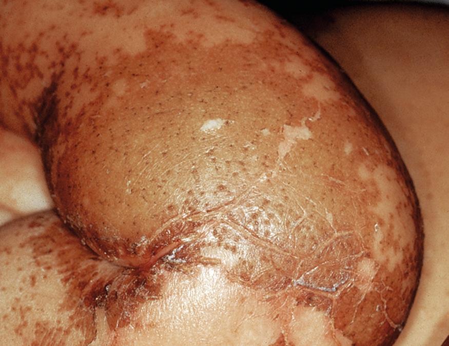 Fig. 39.1, Enamel paint dermatosis in a child with kwashiorkor.