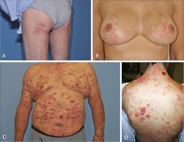 Figure 104.1, Patients with mycosis fungoides, presenting with limited (A and B) patches or plaques that are typically involving the bathing suit areas and patients with disseminated patches or plaques and tumors (C and D).