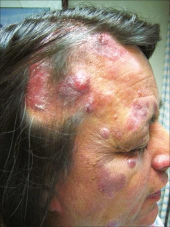 Figure 104.2, Patient with folliculotropic type of mycosis fungoides with involvement of the face and scalp and associated alopecia.