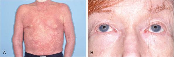 Figure 104.3, Patient with Sézary syndrome who has generalized erythroderma and thickening (lichenification) of the skin (A) with ectropion of the lower eyelids (B).