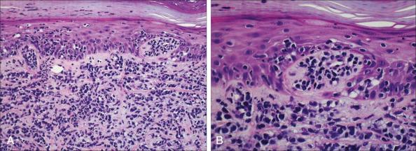 Figure 104.4, Histopathological findings of mycosis fungoides demonstrating a superficial dermal band–like infiltrate with atypical lymphocytes with hyperchromatic, hyperconvoluted nuclei, variable findings of inflammatory cells, and epidermotropism with infrequently seen Pautrier microabscesses. (Hematoxylin and eosin; original magnification ×200 [A] and ×400 [B].)