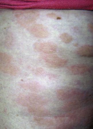 FIGURE 4-2, Urticarial plaques caused by urticarial vasculitis.