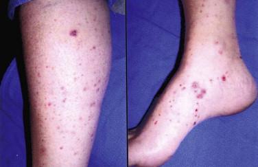 FIGURE 4-3, Petechial and purpuric macules in a patient with cutaneous leukocytoclastic vasculitis secondary to an adverse drug reaction.