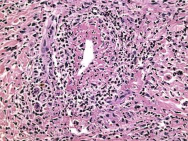 FIGURE 4-4, Small vessel neutrophilic vasculitis (leukocytoclastic vasculitis) is identified by the presence of fibrin deposits, nuclear debris, and neutrophils disrupting a postcapillary venule.