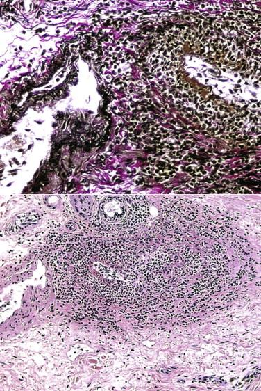 FIGURE 4-5, Neutrophilic muscular vessel vasculitis associated with lost of the elastic lamina (elastic tissue stain, top ).