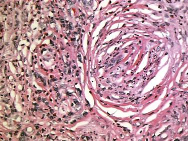 FIGURE 4-6, Angiocentric fibrosis and focal small vessel vasculitis found in a cutaneous inflammatory pseudotumor.