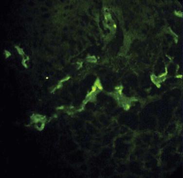 FIGURE 4-7, Vascular C3 deposition is the most frequent immunofluorescent finding in patients with cutaneous vasculitis.
