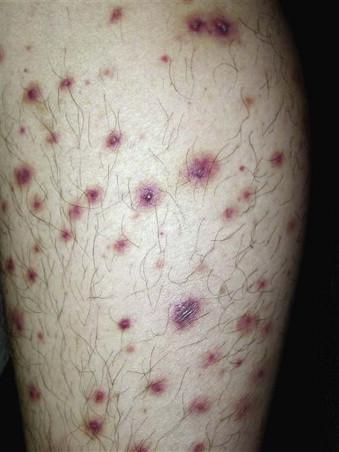 FIGURE 4-9, Palpable purpura and purpuric vesicles in a patient with cutaneous leukocytoclastic vasculitis associated with a recent upper respiratory tract infection.