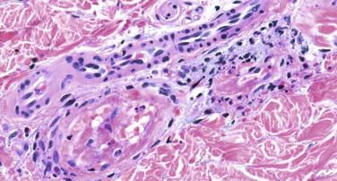 FIGURE 4-10, Levamisole-induced vasculitis shows histologic signs of a vasoocclusive disorder and vasculitis.