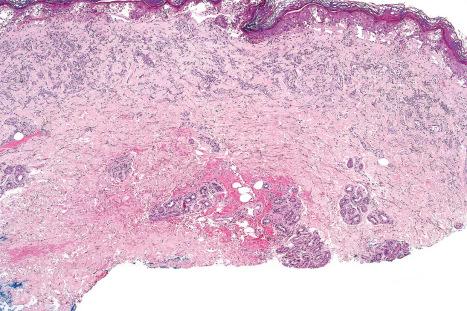 Fig. 14.16, Phototoxic drug reaction: this is a very severe reaction. Dermal edema has resulted in subepidermal vesiculation.