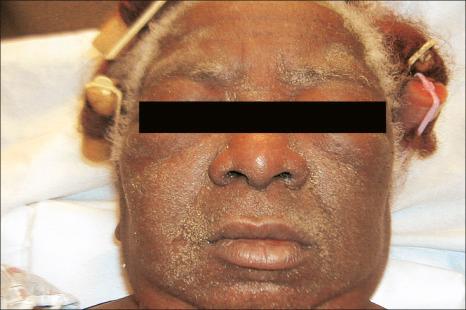 Fig. 14.18, Anticonvulsant hypersensitivity syndrome: there is striking facial edema with periorbital accentuation.