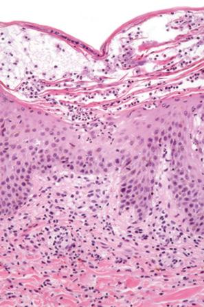 Fig. 14.20, Anticonvulsant hypersensitivity syndrome: this example shows a subcorneal pustule.