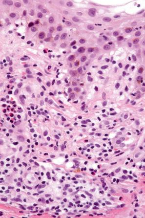 Fig. 14.21, Anticonvulsant hypersensitivity syndrome: the underlying dermis shows a superficial dermal perivascular lymphohistiocytic infiltrate with scattered eosinophils.