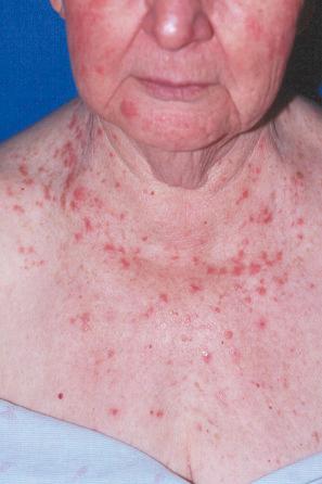 Fig. 14.22, Lichenoid drug reaction: lichenoid papules are widely distributed about the patient's face and upper chest.